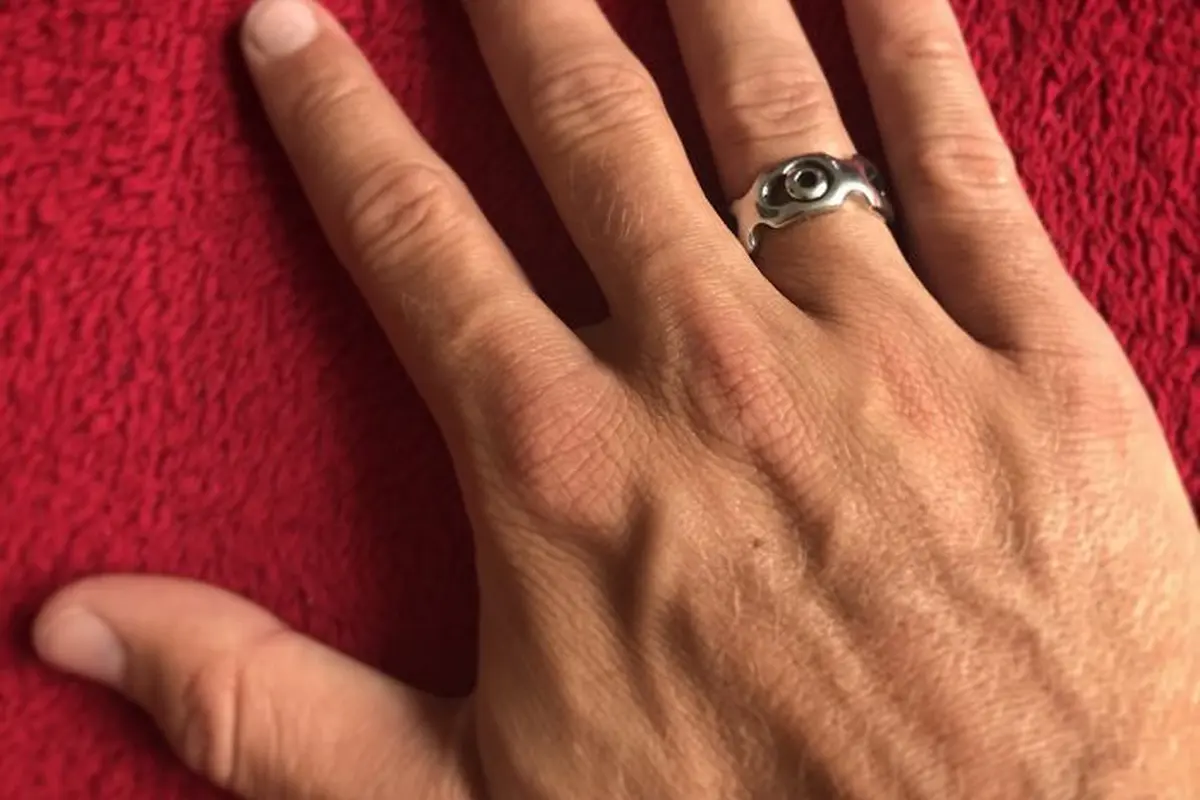 [Bintang] Kreatif! Pria Ini Bikin Cincin dari Logam Penyangga Patah Tulang