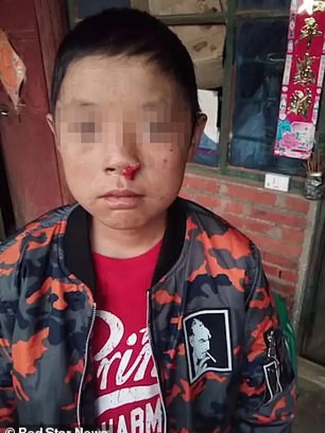Bocah 12 Tahun Idap Penyakit Mirip Drakula, Bila Terkena Sinar Matahari