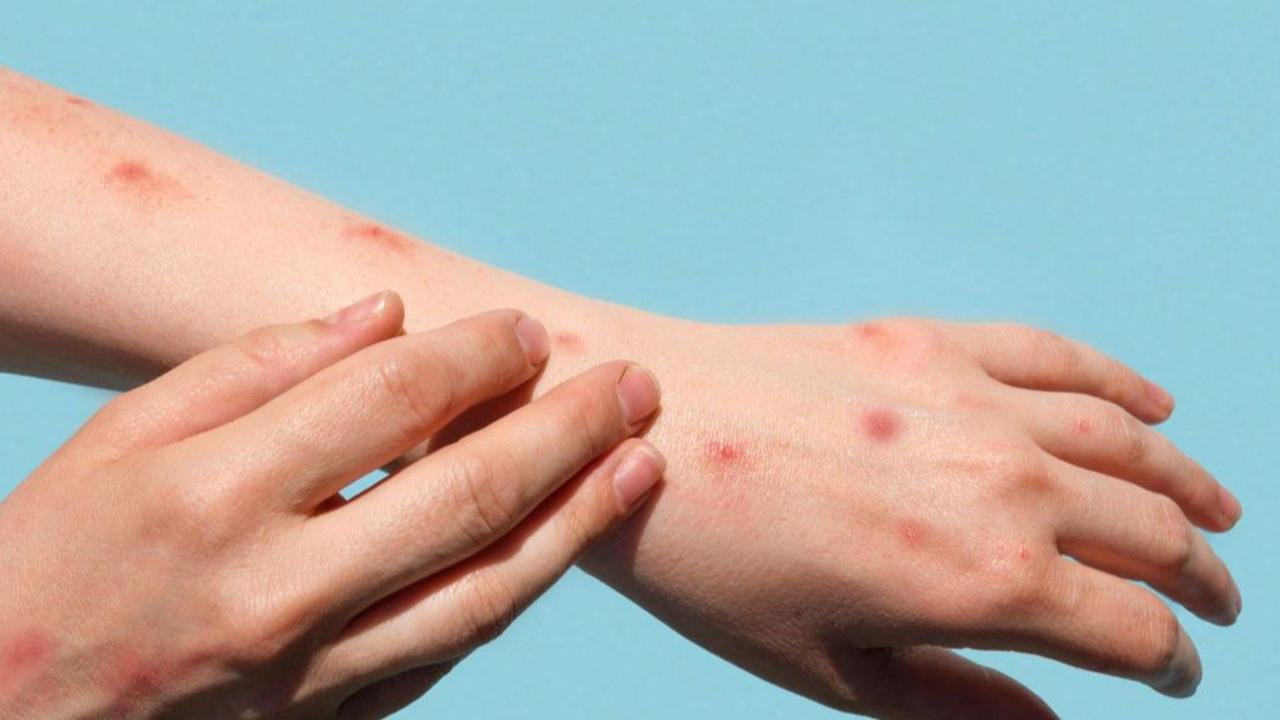 29 Oktober Hari Psosiasis Sedunia, Penyakit Autoimun yang Perlu Diwaspadai
