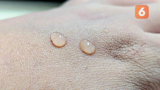 Kulit Luka Terkena Hujan yang Mengandung Mikroplastik, Dokter: Bisa Picu Peradangan Kronik Ringan