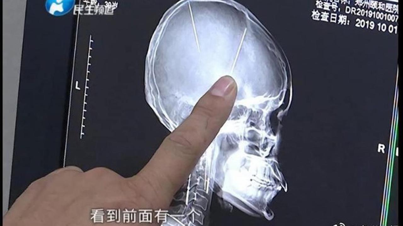 Tak Pernah Mengeluh Sakit Kepala, Wanita Ini Kaget Ada Jarum Tertanam di Otaknya