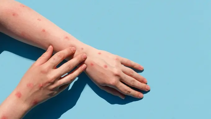 Tips Menjaga Kesehatan Kulit Bila Terserang Monkeypox