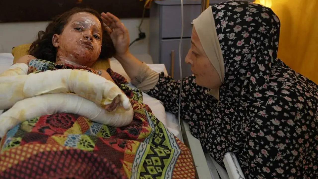 70 Persen Korban Luka Bakar di Gaza adalah Anak-Anak, Sebagian Besar di Bawah Usia 5 Tahun
