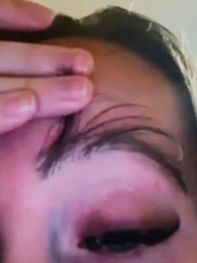 Transplantasi Rambut Bikin Alis Wanita Ini Tumbuh Panjang Sampai Harus Sering Dipotong