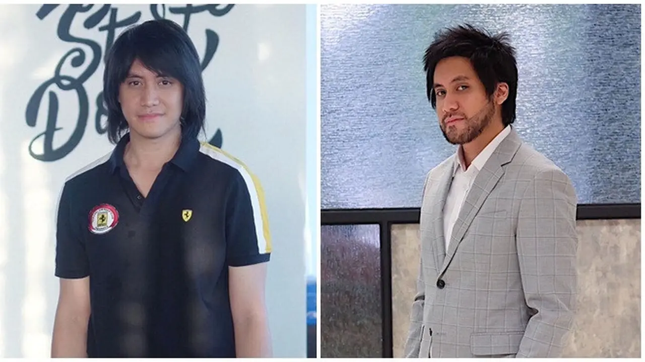 7 Potret Kevin Aprilio Usai Transplantasi 6.600 Helai Rambut, Jadi Kepuasan pribadi