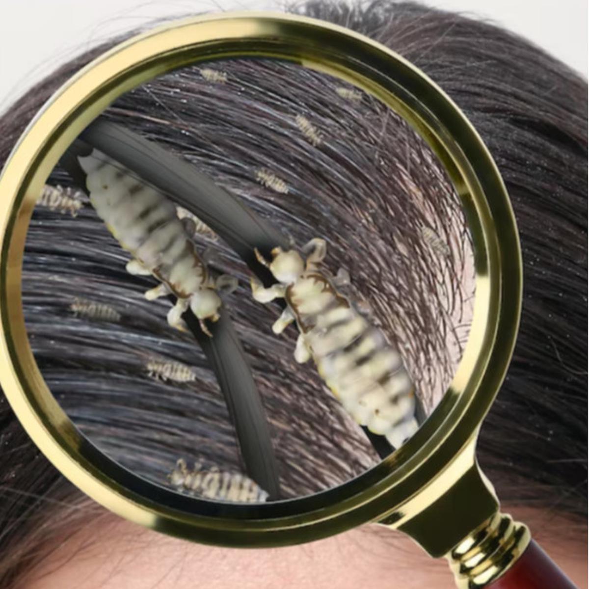Say Goodbye to Kutu Rambut: Mengatasi Kutu Rambut dalam 5 Langkah