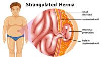Ilustrasi penyakit hernia. (Photo created by brgfx on www.freepik.com)