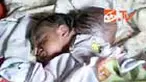 Pasangan suami istri, Maimunah dan Sapayadi, tak punya biaya operasi bagi anak ketiganya yang lahir dengan dua kepala. Penghasilan sebagai petani tak cukup. 