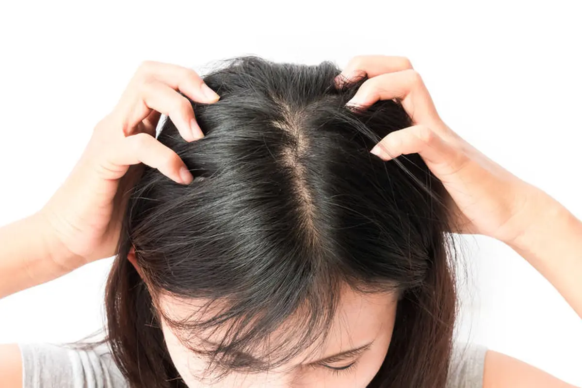 Fakta Tentang Kutu Rambut yang Anda Harus Tahu