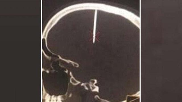 Mengeluh Sakit Kepala, Ternyata Ada Paku di Tengkorak Pria Ini