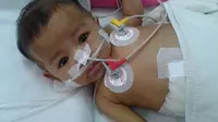Derita Atresia Bilier, Bayi Masha Butuh Bantuan