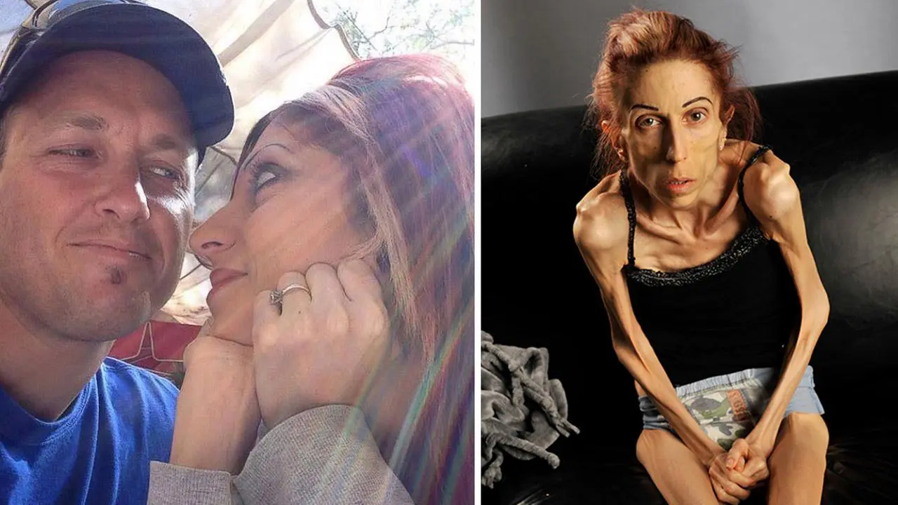 Wanita Ini Berjuang Melawan Anoreksia Selama 10 Tahun