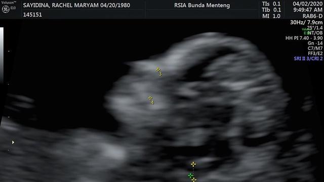 Mengandung Anak Kedua di Usia 40 Tahun, Ini 6 Potret Rachel Maryam dan Suami