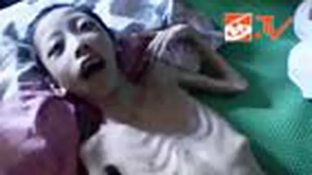 Bocah Penderita Gizi Buruk Dibawa ke Puskesmas Mako