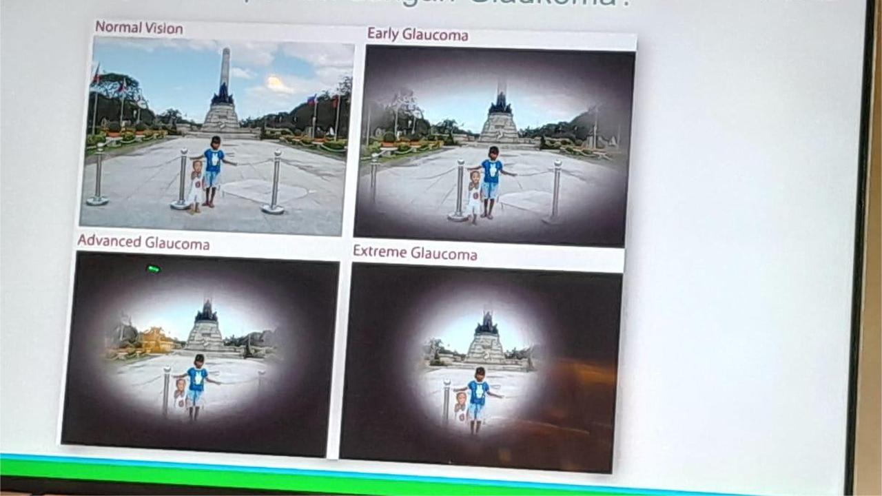 Point of View Pasien Glaukoma Saat Melihat yang Diterangkan dokter spesialis mata konsultan oftalmologi, Iwan Soebijantoro dari JEC Eye Hospitals and Clinics.