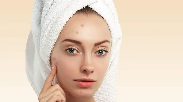 ilustrasi kulit jerawat/pexels