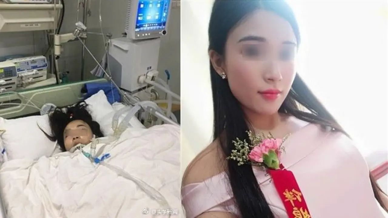 Jadi Bridesmaid Tanpa Istirahat, Kaki Gadis Ini Harus Diamputasi