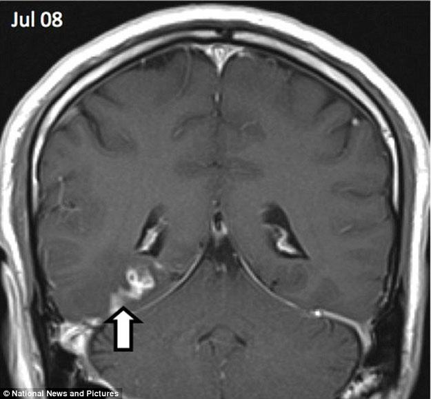 Cacing pita parasit berjalan dari otak sebalah kanan ke sebelah kiri | dailymail.co.uk