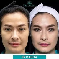 Potret Iis Dahlia sebelum dan sesudah tanam benang (Sumber: Instagram/dermaster_id)