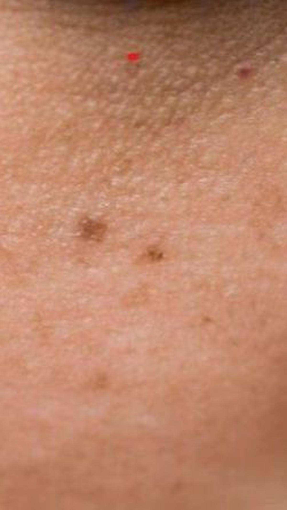 <b>Penyebab Flek Hitam di Wajah</b>