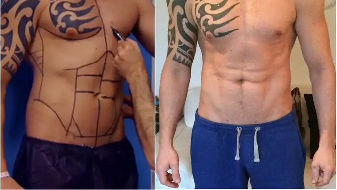 Agar Six Packs, Pria Ini Relakan Rp 71 Juta untuk Operasi