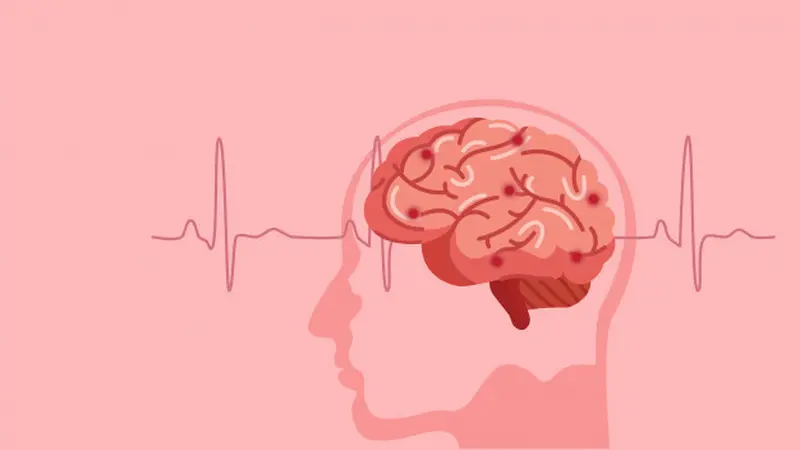 Ilustrasi Pengaruh Kesehatan Otak dan Stroke