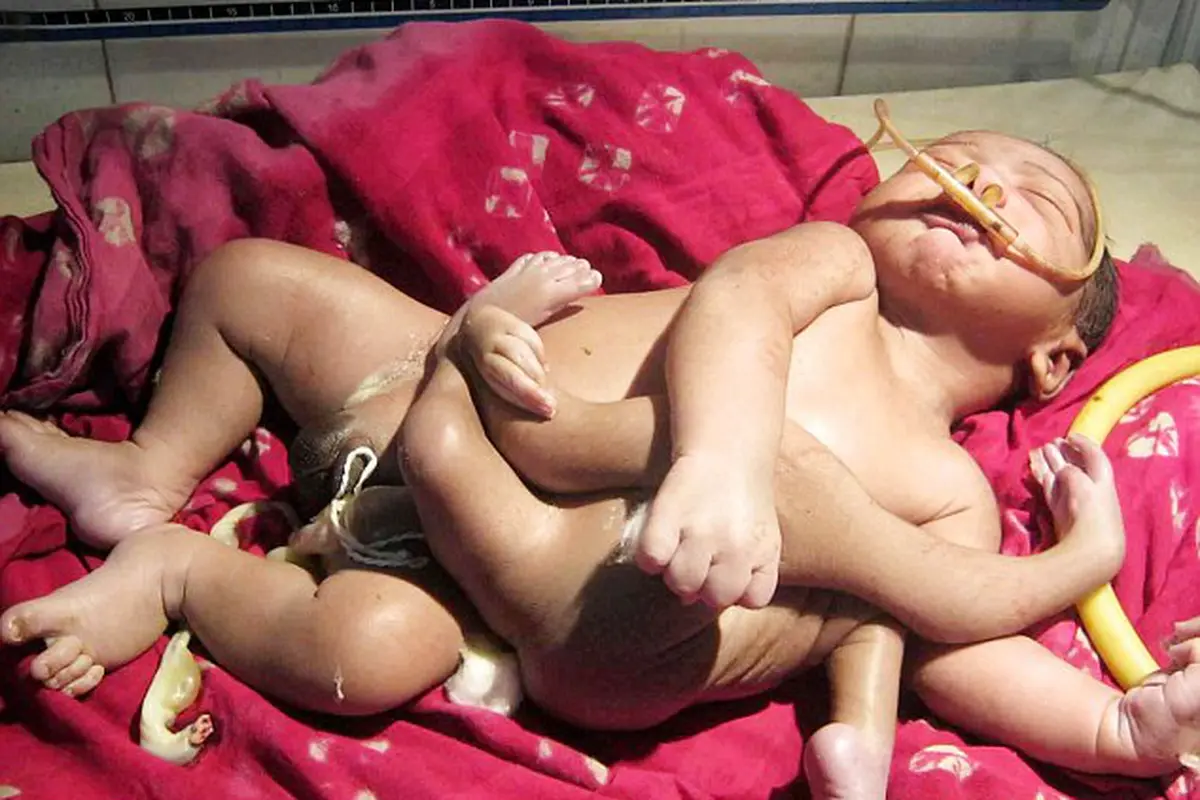 Heboh Bayi Punya Kaki & Tangan 2 Pasang, Titisan Dewa India?