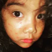 Anak Sheila Marcia sedang terkena cacar (Instagram/@sheilamarciajoseph)