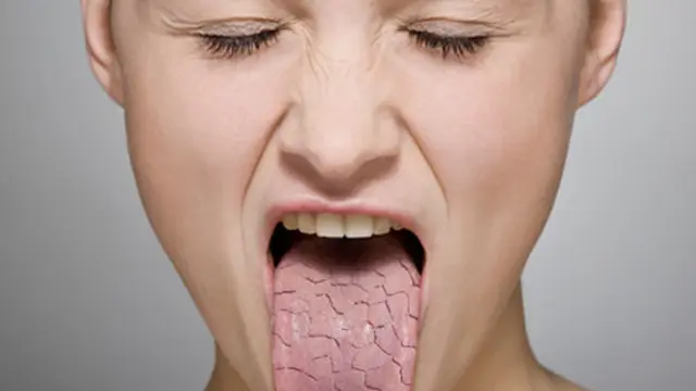 Mulut Kering Pertanda Diabetes?