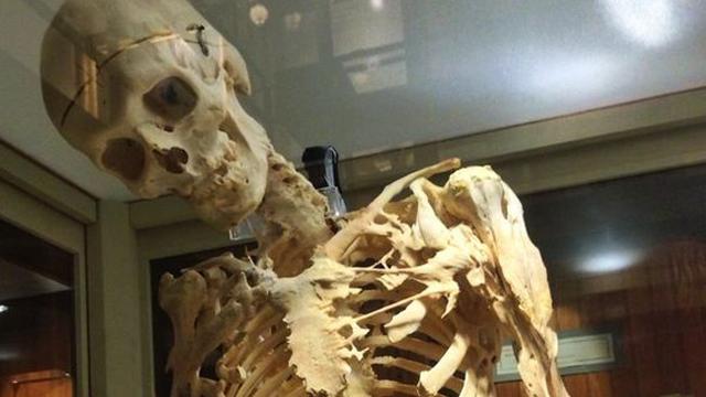 Kerangka tubuh Harry Eastlack