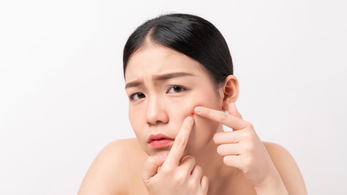 9 Cara Cepat Mengempiskan Jerawat dengan Aman, Kembalikan Kepercayaan Diri