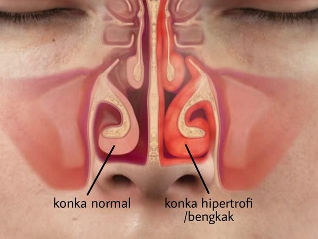 hidung berdarah sebelah kiri