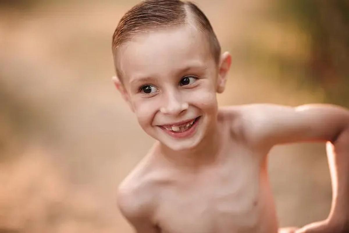 Cara Mencegah TBC pada Anak Stunting, Fakta Mengenai Risiko dan Tips Penting untuk Orang Tua