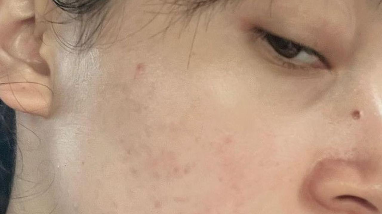 Kini, Kondisi wajah Megan Domani pun sudah jauh lebih baik usai mendapatkan dokter dan perawatan yang cocok untuk kulitnya. Kendati, dia masih terus berusaha untuk menghilangkan bekas jerawat yang masih terlihat.