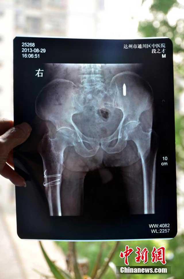 Peluru yang bersarang di tubuh kakek Duan | Photo: Copyright shanghaiist.com
