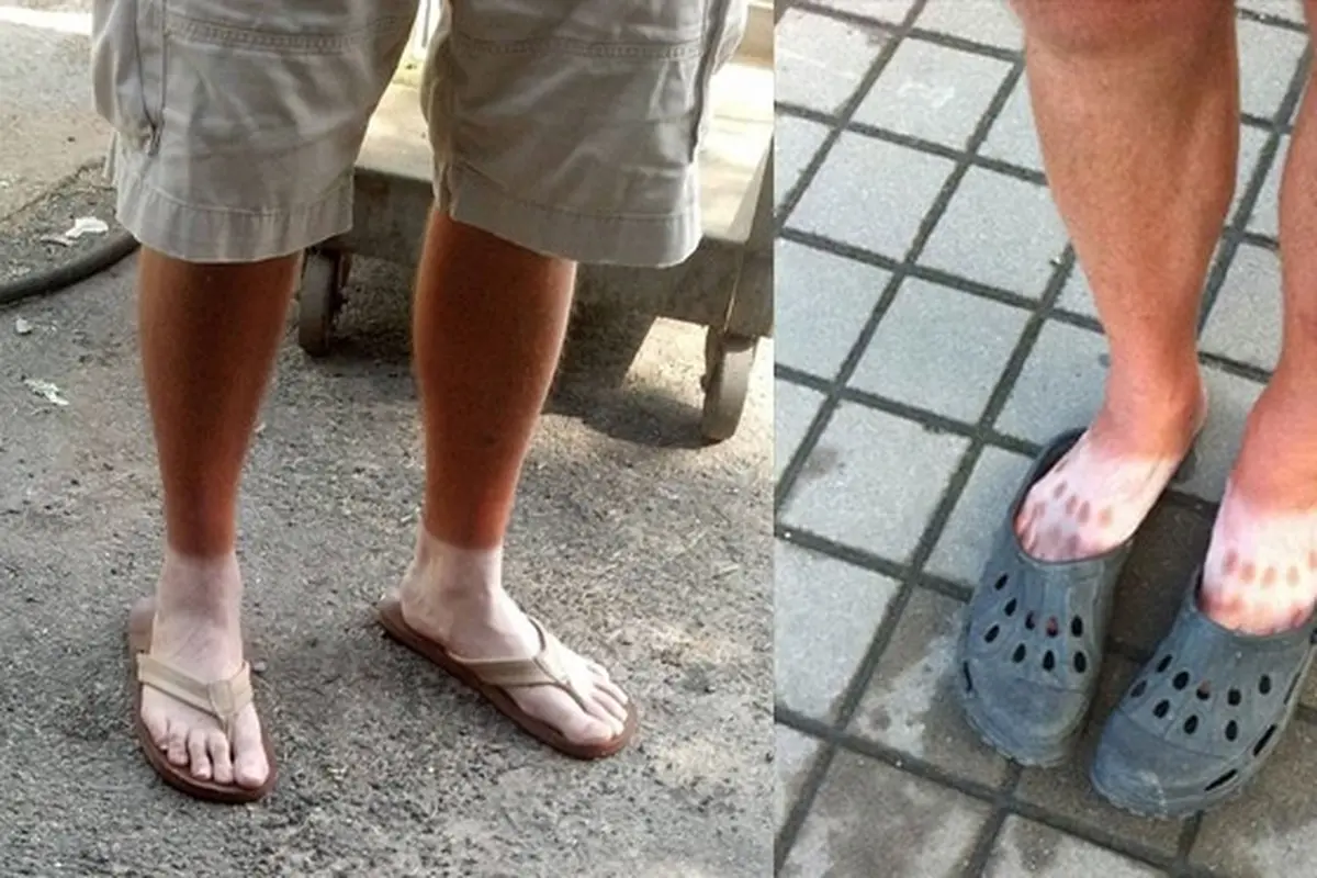 6 Potret Orang Belang di Kaki Karena Panas Ini Bikin Senyum