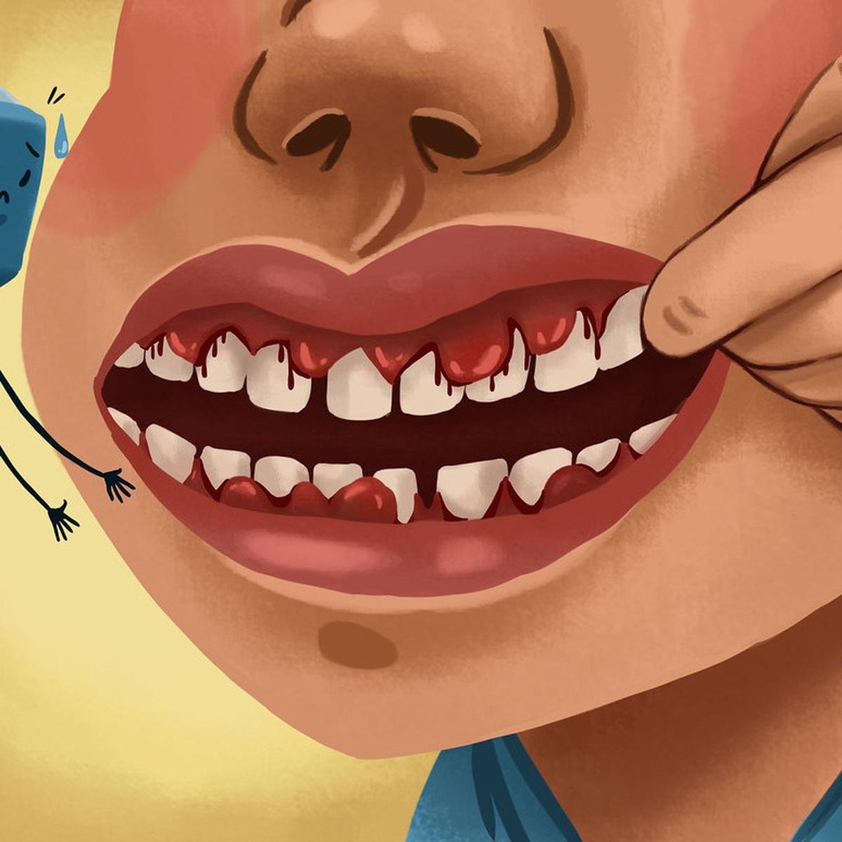 Ilustrasi Radang Gusi