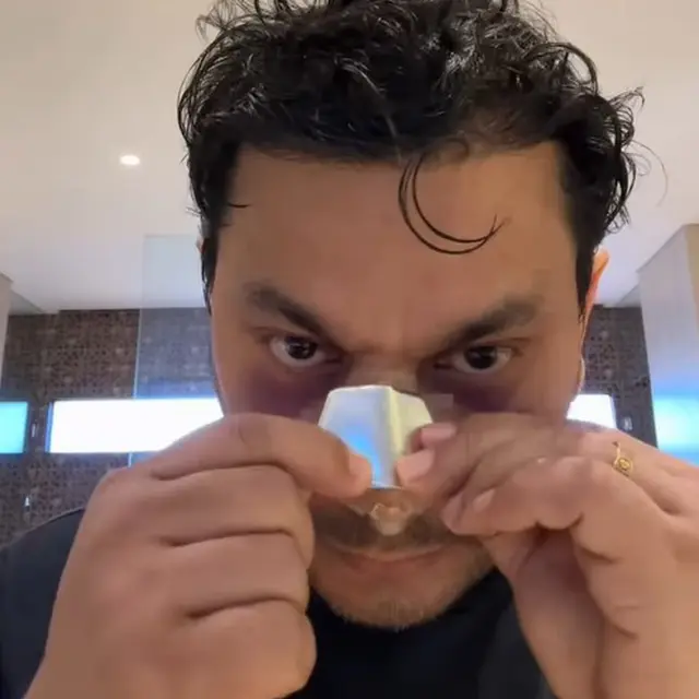 Potret Terbaru Tompi Usai Jalani Operasi Plastik Hidung