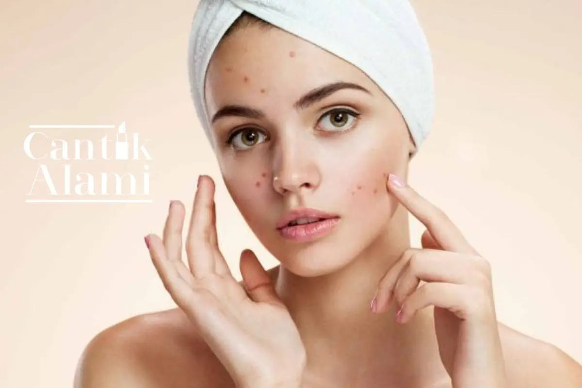 Cantik Alami: Mengatasi Wajah Kemerahan Akibat Jerawat