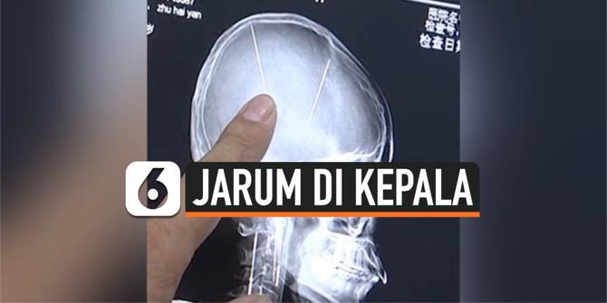 VIDEO:  Dokter Temukan 2 Jarum di Tengkorak Kepala Wanita