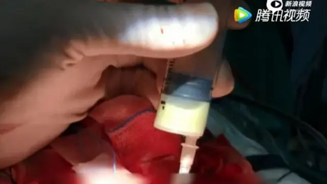 Anak 10 tahun alami pembedahan otak karena dipencet komedonya