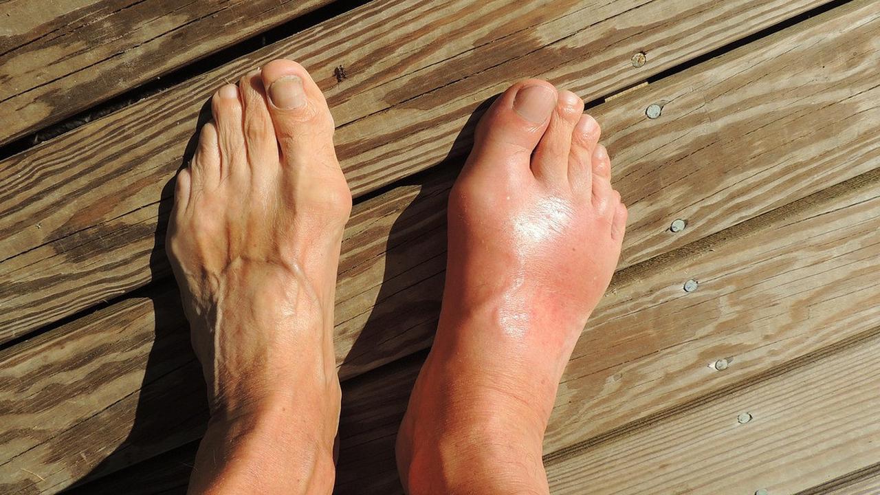 Waspadai! Ini 7 Gejala Asam Urat yang Sering Muncul di Kaki