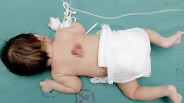 Kondisi Langka, Bayi Ini Lahir dengan Penis Ekstra di Punggung