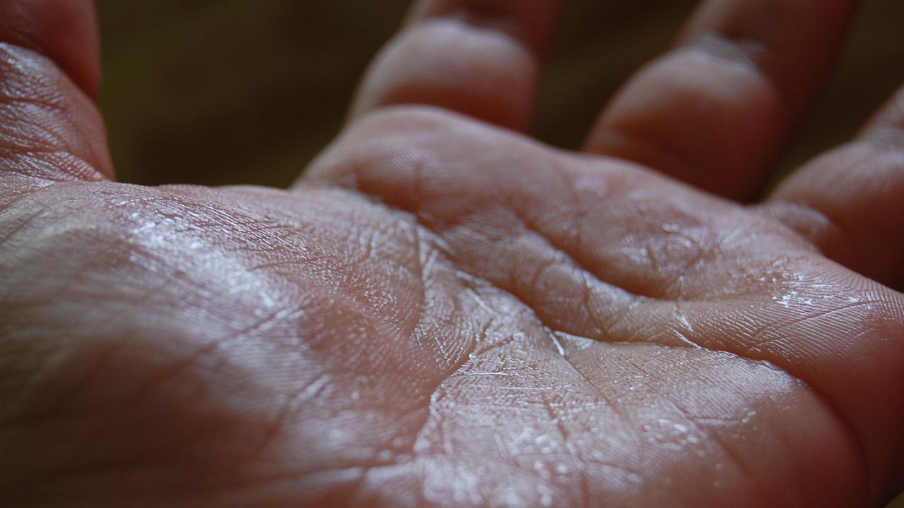 Mengapa Tangan dan Kaki Berkeringat? Tinjauan Medis di Balik Hiperhidrosis