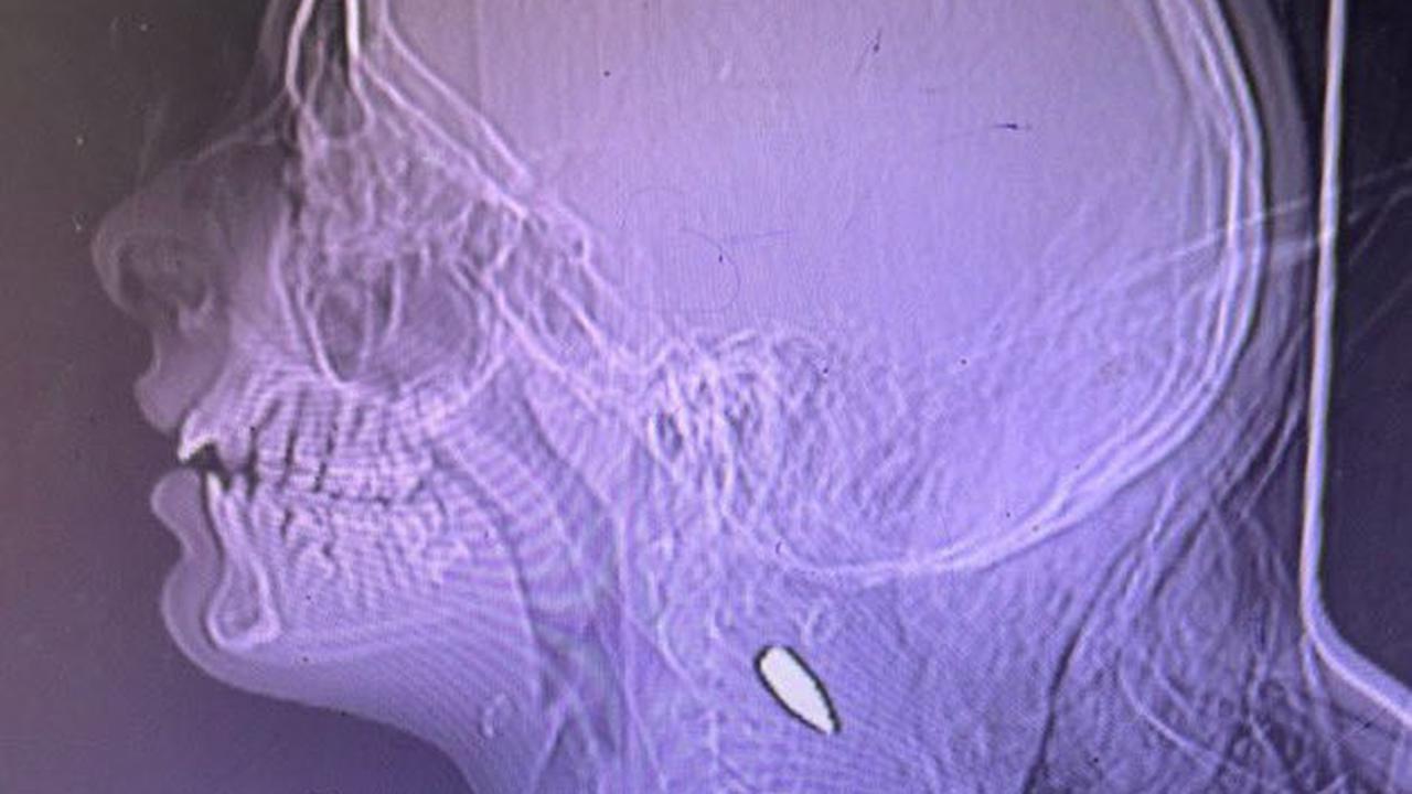 Hasil scan X-ray anak-anak di Gaza yang ditembak sniper Israel.