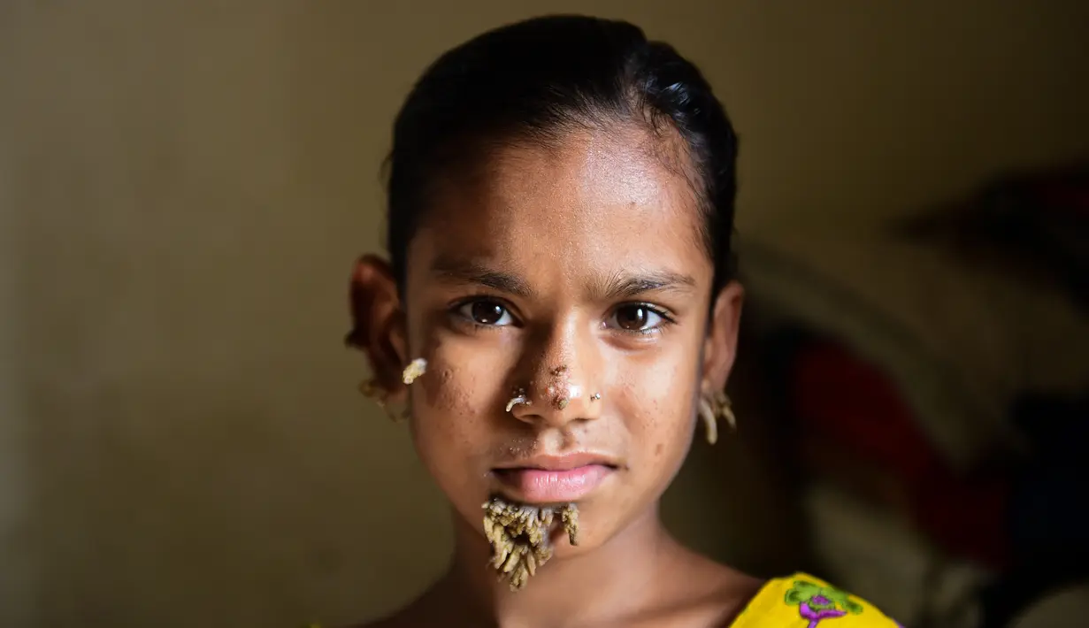 Sahana Khatun ditemui saat menjalani perawatan di sebuah rumah sakit di Dhaka, Bangladesh, 30 Januari 2017. Gadis 10 tahun tersebut tengah dirawat karena mengalami kondisi langka yang dikenal sebagai sindrom "manusia pohon". (STR/AFP)