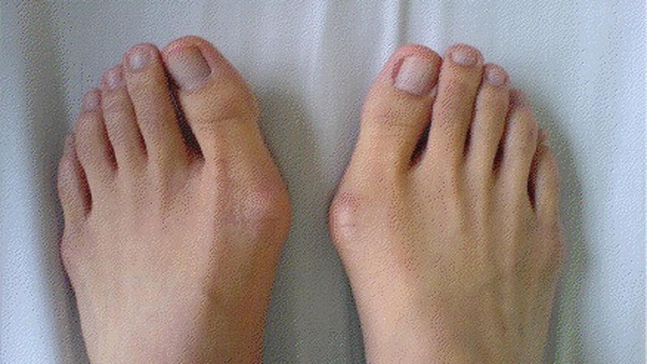 Bunion