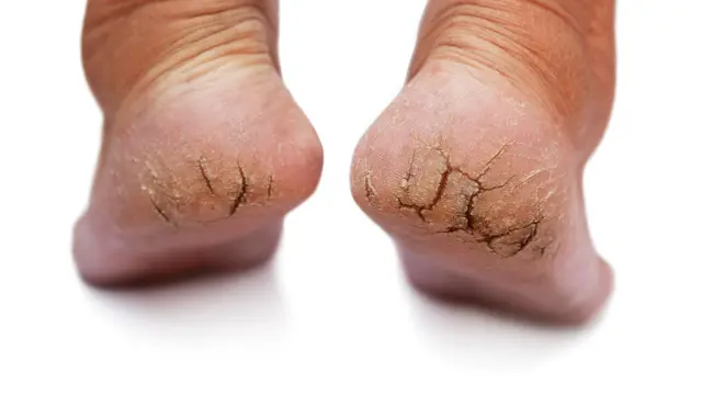 Penyebab Telapak Kaki Pecah-pecah