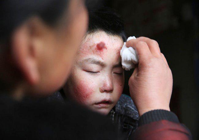 Dengan sabar sang ibu membersihkan luka di wajah Liuchen | foto: copyright chinadaily.com.cn