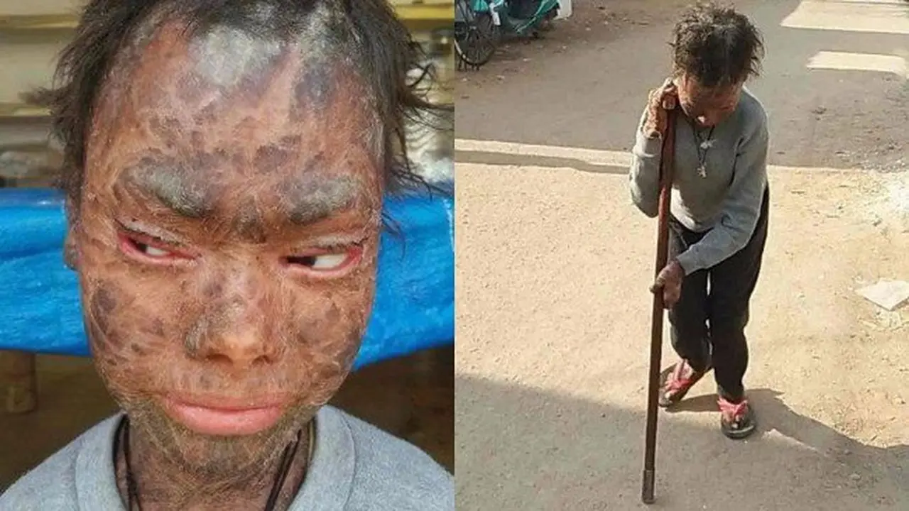Alami Penyakit Langka, Penampilan Gadis Ini Bikin Warga Takut